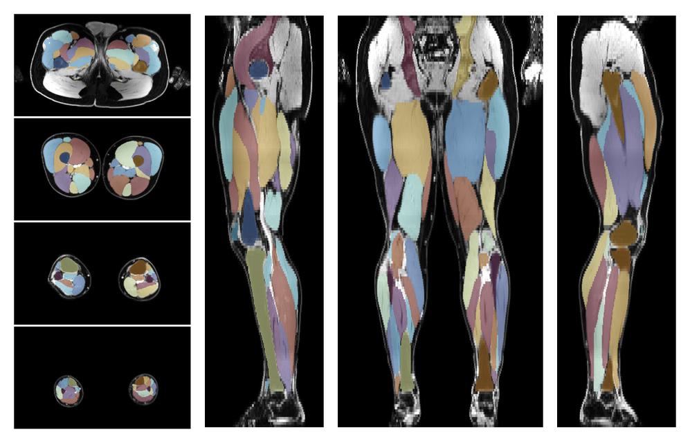 Overlay of automated muscle segmentation labels on dixon water image.